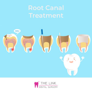 root canal treatment