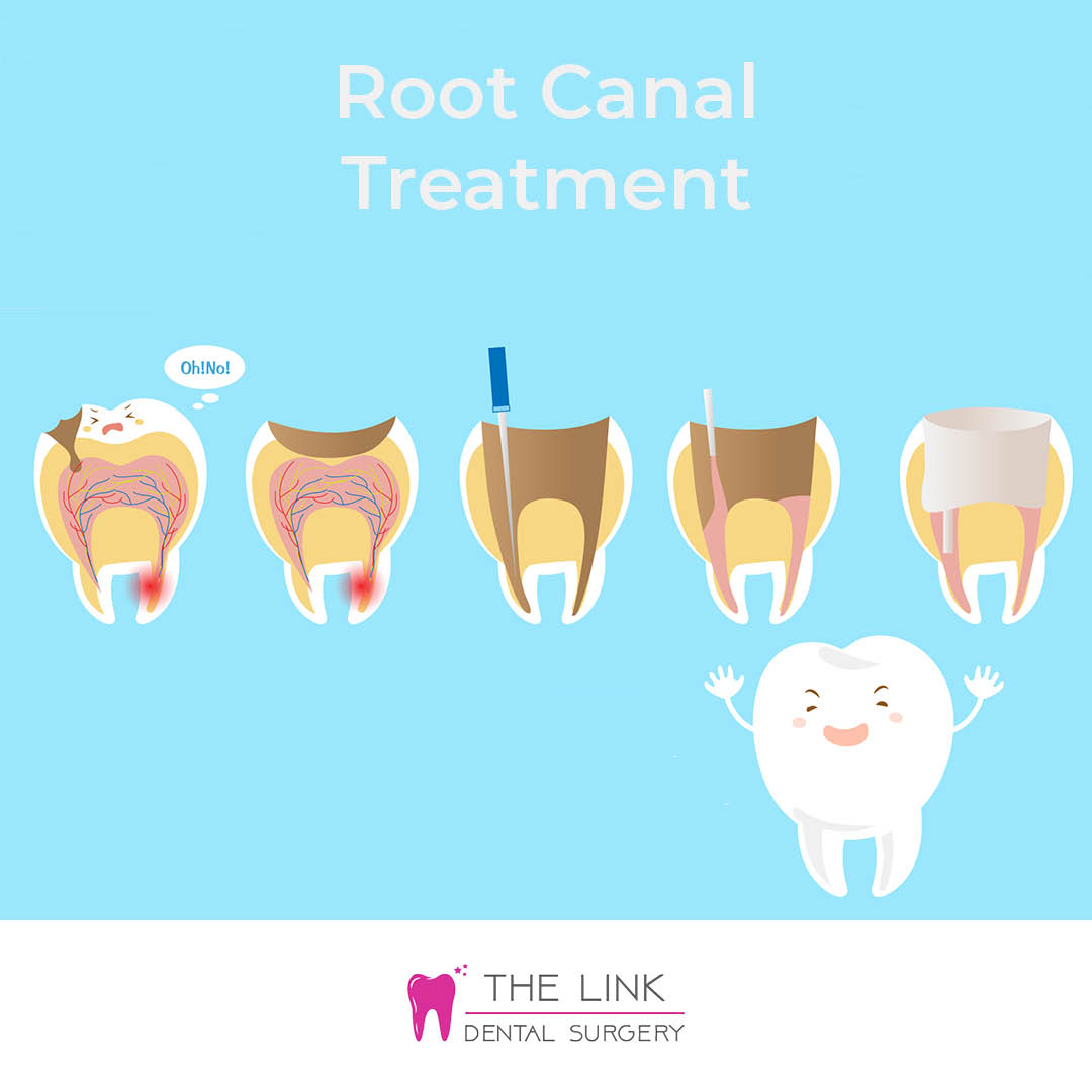 Root Canal Treatment | The Link Dental Surgery | Hampshire Dentist