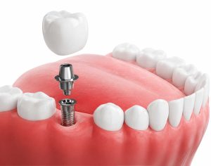 Dennis has extensive postgraduate knowledge in restorative and cosmetic
dentistry including crowns, veneers, composite edge bonding and Invisalign.
Over the years